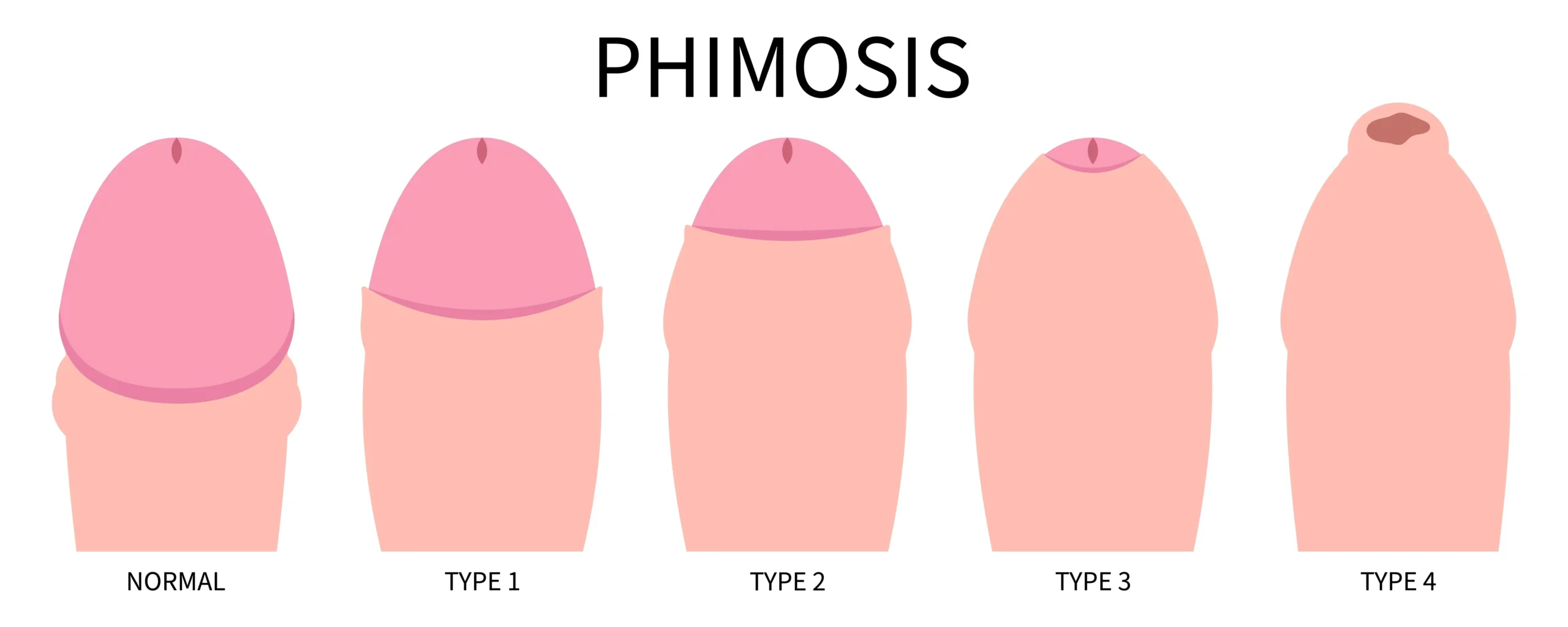 Phimosis Tight Foreskin Treatment and Circumcision in London